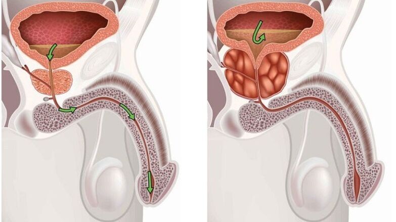 healthy and inflamed prostate with prostatitis