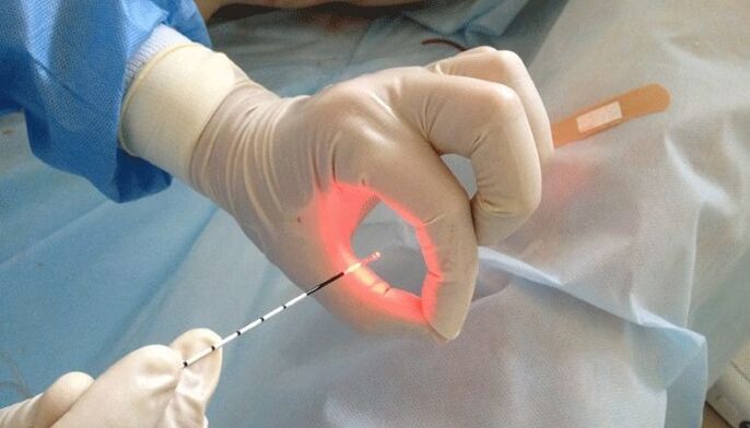 laser treatment of prostatitis